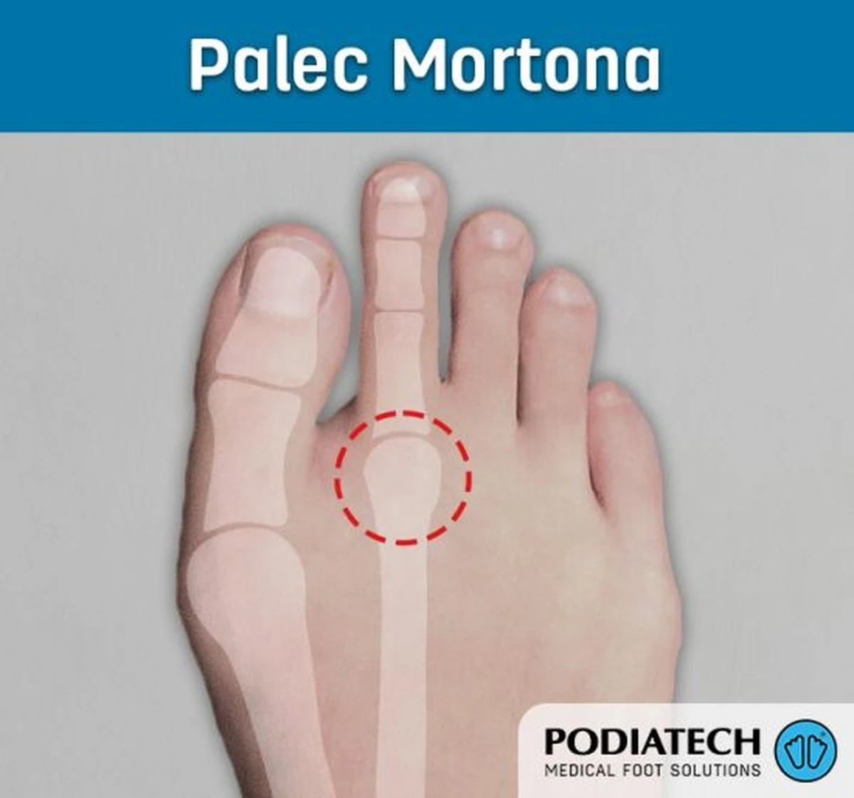 Ten błąd w ustawieniu palców u nóg kosztuje Cię stabilność i powoduje ból mięśni. Czy masz Mortona stopę? - image 1