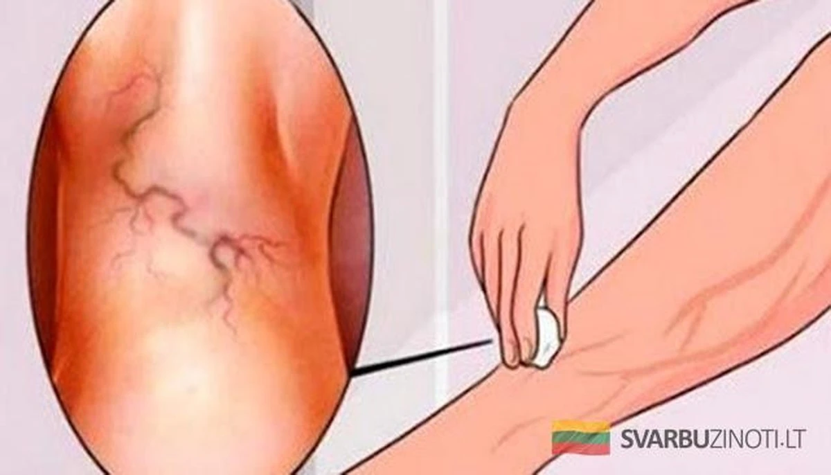 Jak powstrzymać żylaki w 2 krokach – i sposób, by nigdy ich nie mieć